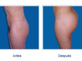 Gluteoplastia