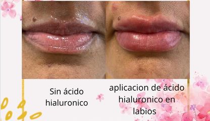 Aumento de labios - Dra. Lady Mora y Dr. Juan Felipe Acosta