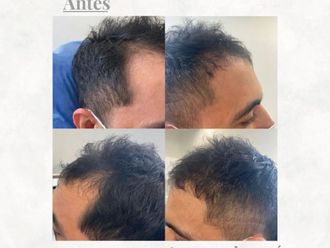 Implantes de cabello - 851026