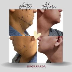Lipopapada - Dra. Lady Mora y Dr. Juan Felipe Acosta