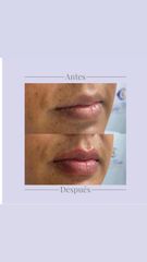 Aumento de labios - Dra. Lady Mora y Dr. Juan Felipe Acosta