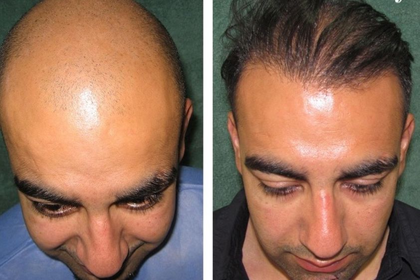 Alopecia antes y después - 581363