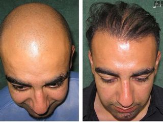 Alopecia grado 7