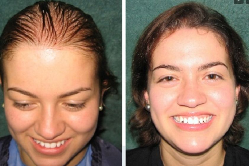 Alopecia antes y después - 581364