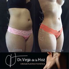 Liposucción - Dr. Edwin Vega De La Hoz