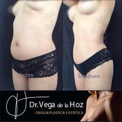 Liposucción - Dr. Edwin Vega De La Hoz