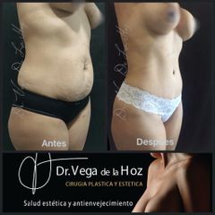 Liposucción - Dr. Edwin Vega De La Hoz