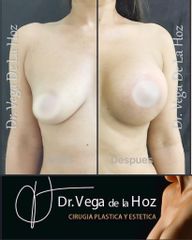 Mamoplastia de aumento - Dr. Edwin Vega De La Hoz