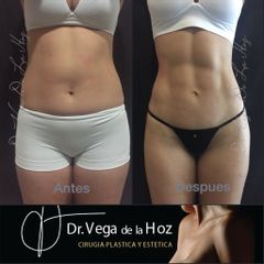 Liposucción - Dr. Edwin Vega De La Hoz
