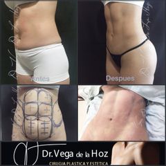 Liposucción - Dr. Edwin Vega De La Hoz