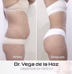 Liposucción - Dr. Edwin Vega De La Hoz