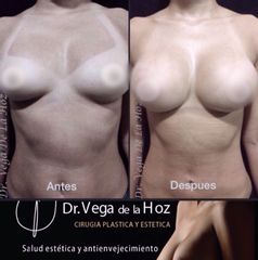 Mamoplastia de aumento - Dr. Edwin Vega De La Hoz