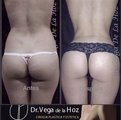 Liposucción - Dr. Edwin Vega De La Hoz