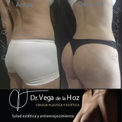 Liposucción - Dr. Edwin Vega De La Hoz