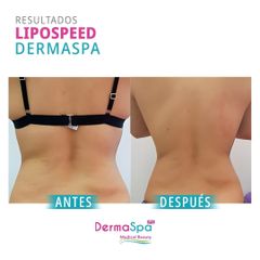 Tratamientos para adelgazar - Dermaspa IPS