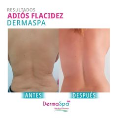 Tratamientos para adelgazar - Dermaspa IPS