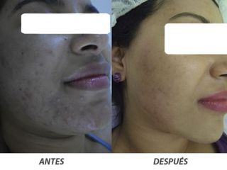 Antes y despues de tratamiento de acne