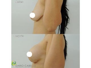 Mamoplastia de aumento