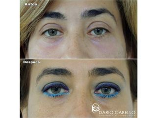 Rejuvenecimiento facial