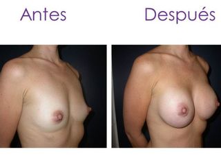 Aumento de senos