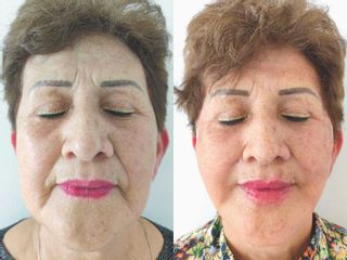 Rejuvenecimiento Facial - Dr. Henry Pallares