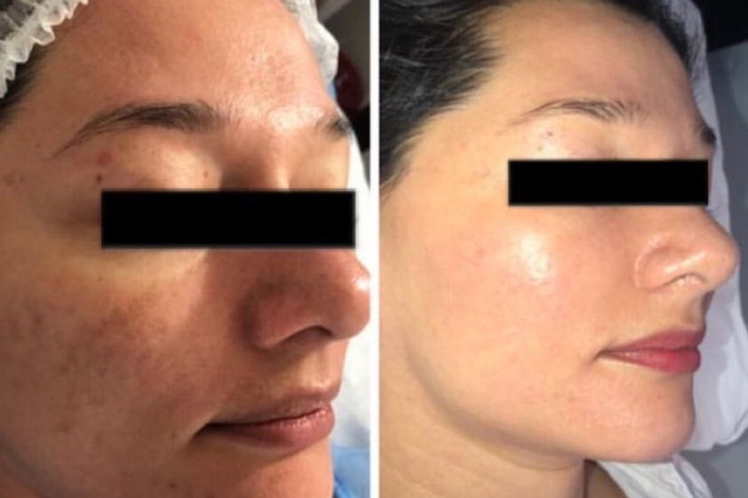 Peeling antes y después - 635060