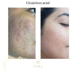 Cicatrices acné - Vima