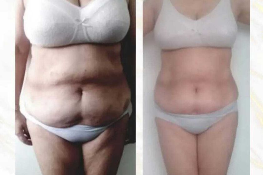 Carboxiterapia antes y después - 812879