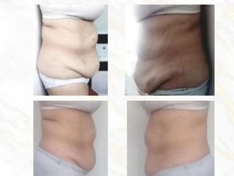 Carboxiterapia antes y después - 812880