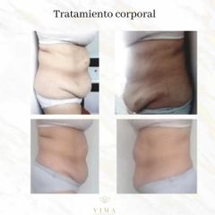 Carboxiterapia - Vima