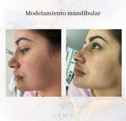 Modelamiento mandibular - Vima