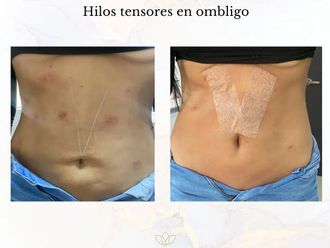 Hilos tensores antes y después - 856421