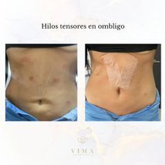 Hilos tensores - Vima