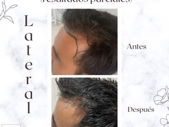 Implantes de cabello - 856422