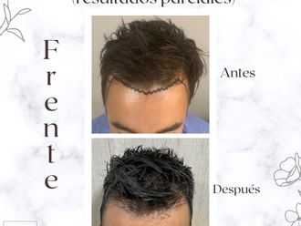 Implantes de cabello - 856424