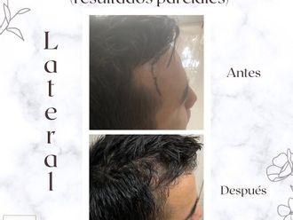 Implantes de cabello - 856428