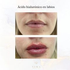 Aumento de labios - Vima