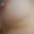 Hola a todos mi nombre es Daniela me realice en el mes de junio mamoplastia de aumento