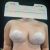 Maxtopexia con liposuccion