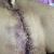 Lipoabdominoplastia
