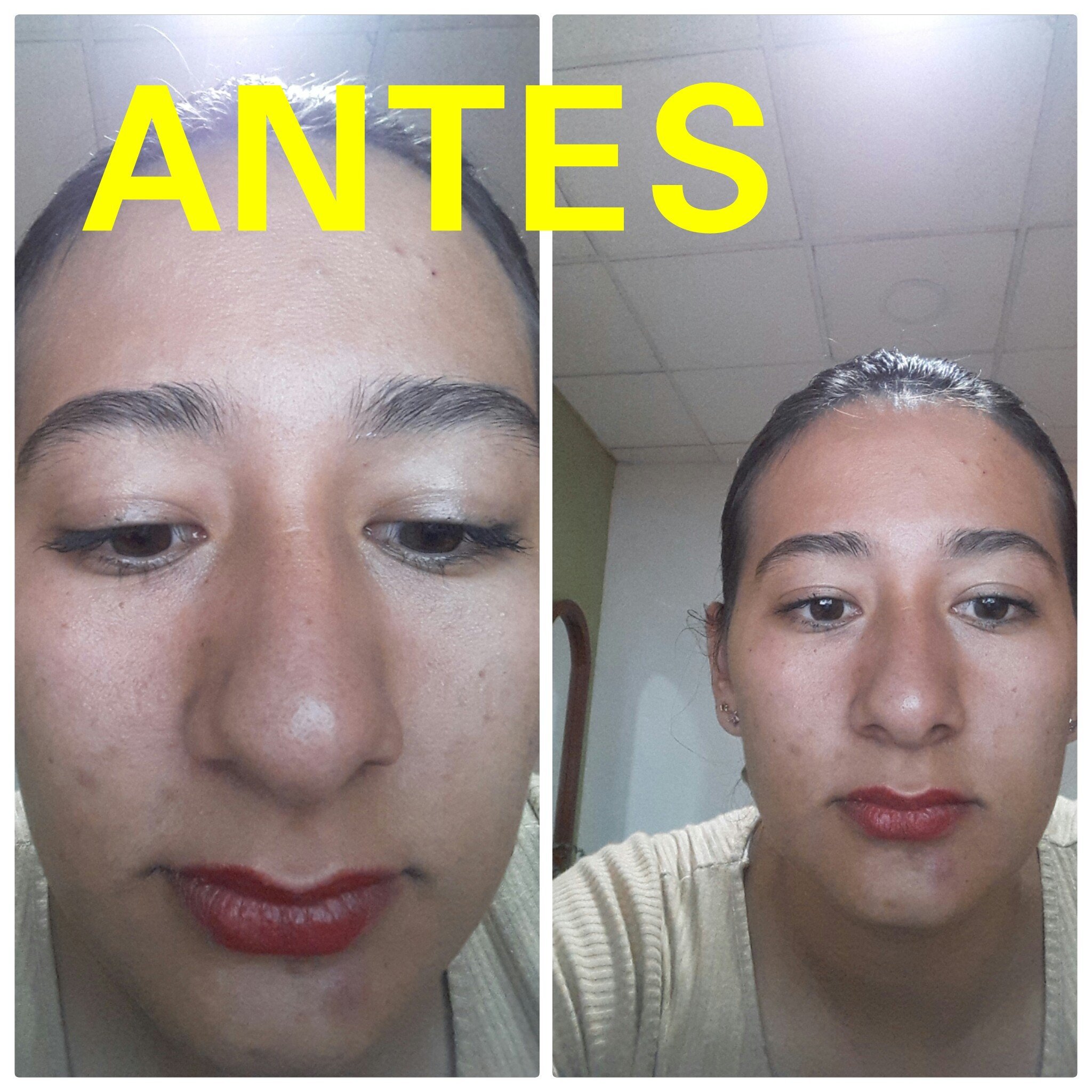 La nariz se siente obstruida después de la rinoplastia La nariz se siente obstruida después de la rinoplastia