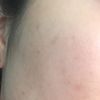 ❤ tengo acné en la frente, mejillas, pecho y espalda
