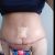 Un deseo aplazado, abdominoplastia llegó la hora