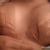 Mamoplastia con Implantes 375 cc, Dra. Barón - Mama tuberosa