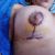 Liposucción, y mamopexia con implante