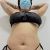 Lipolisis laser y gluteomax- Dr Tobias Gutierrez- Bogota Colombia