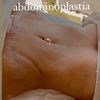 Abdominoplastia más lipo de tronco y lipotransferencia glútea