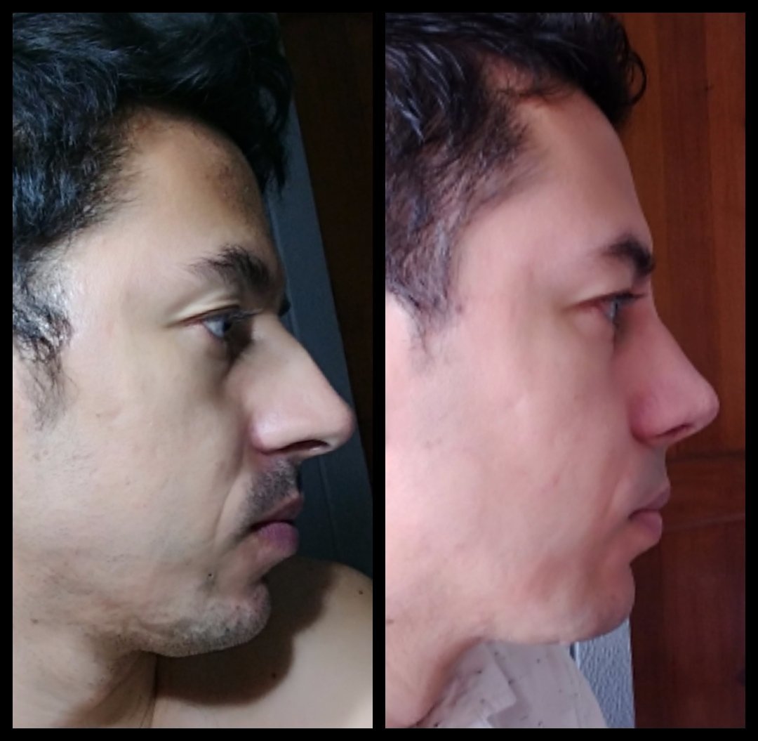 Bienvenidas Las Fotos De Perfil Con Mi Nueva Nariz Rinoplastia Clinicasesteticas Com Co