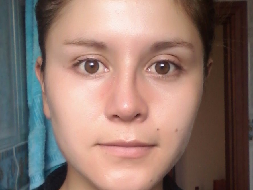 Me Hice Una Rinoplastia Hace 15 Dias Rinoplastia Clinicasesteticas Com Co