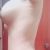 Abdominoplastia con aumento de senos